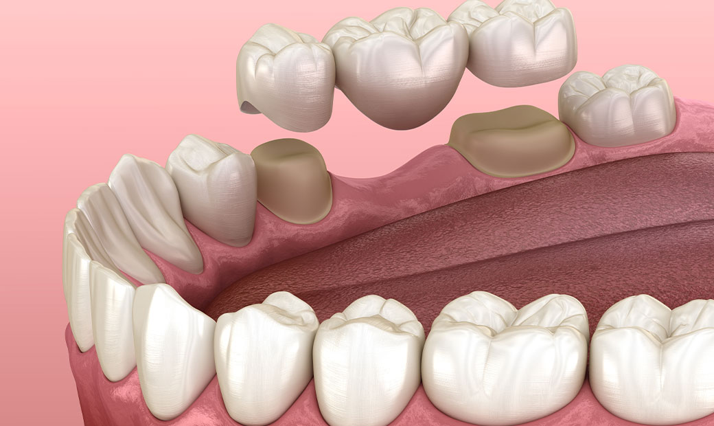歯のブリッジによる治療とは