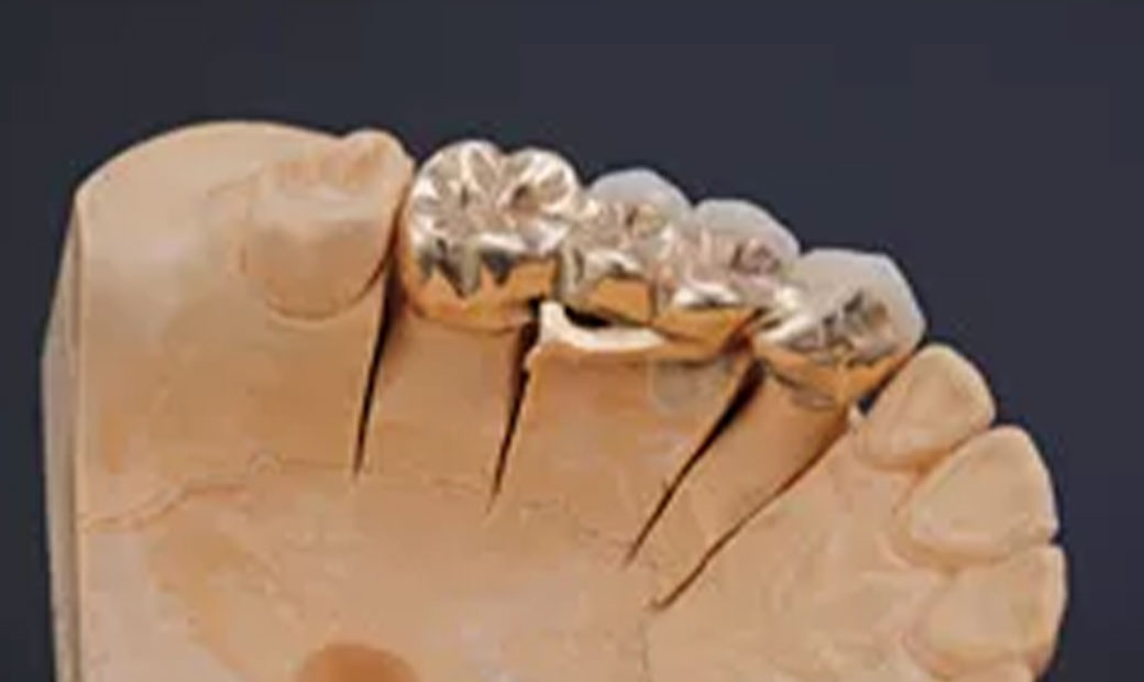 リーゲルアタッチメント義歯