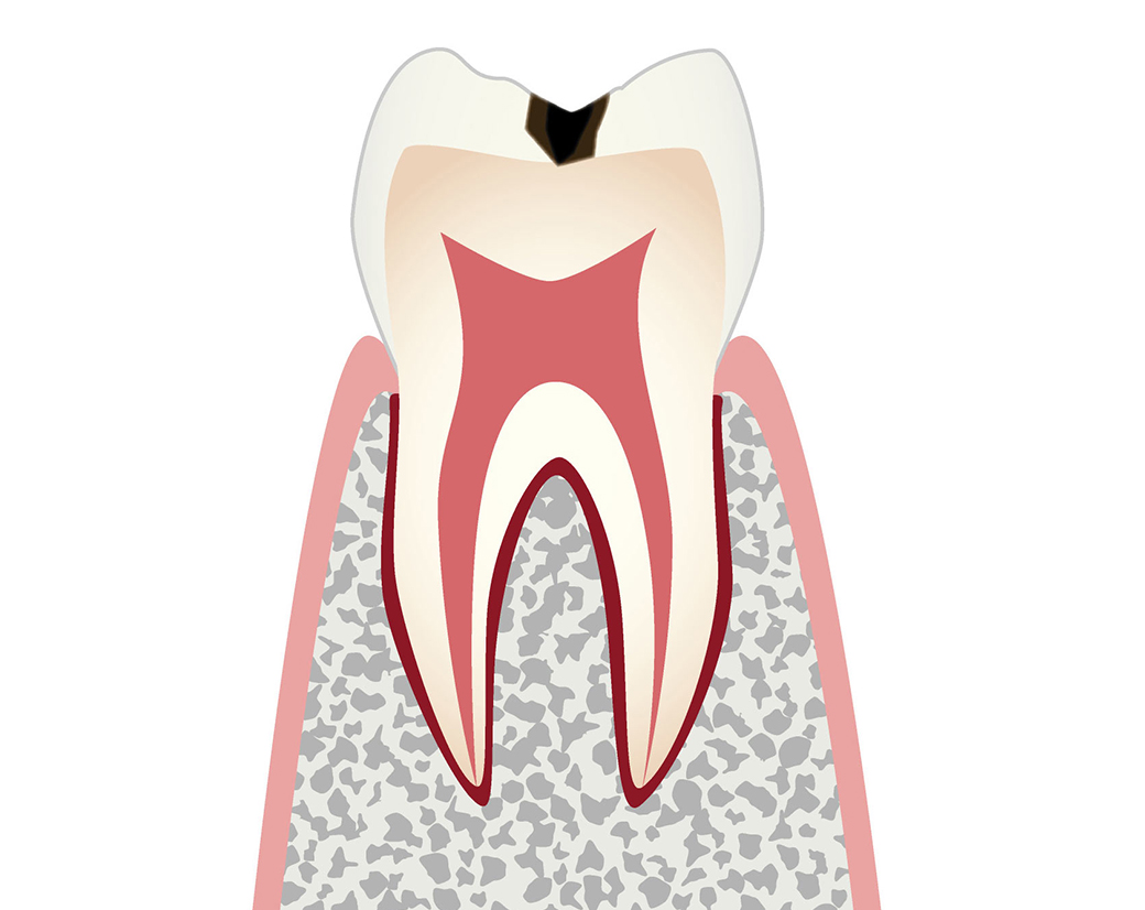 C1：エナメル質が溶け表面に穴が開いている状態