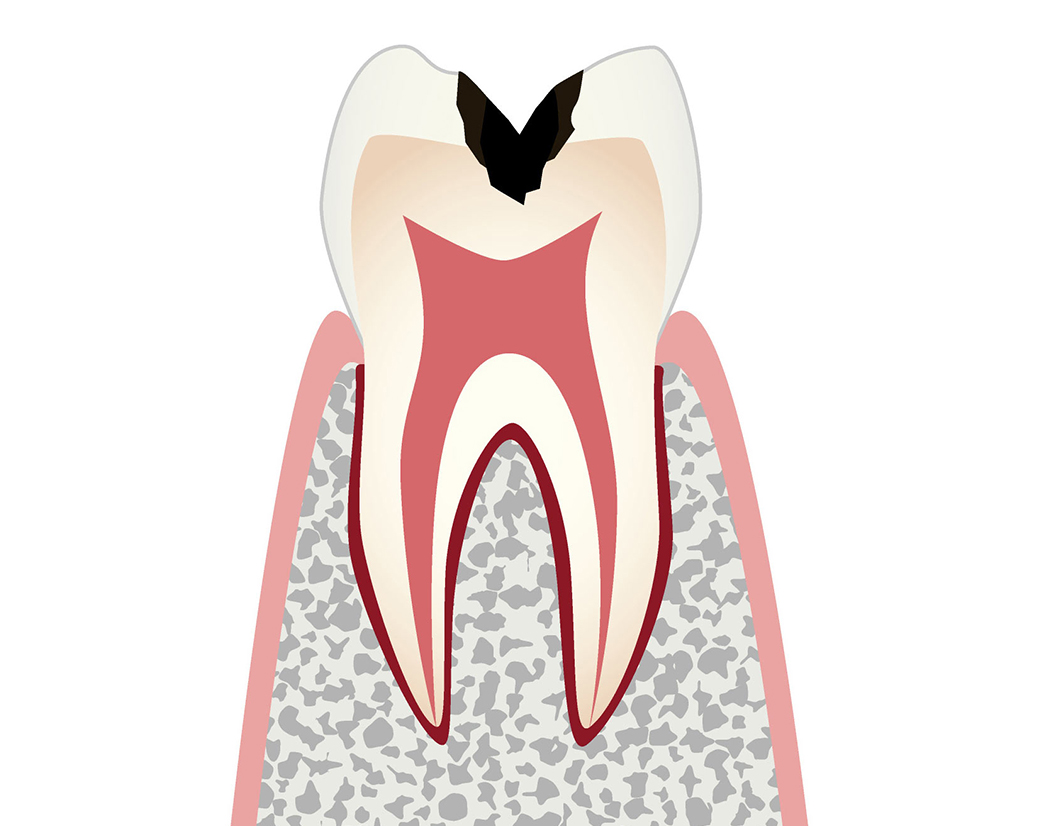 C2：穴が象牙質にまで拡大している状態
