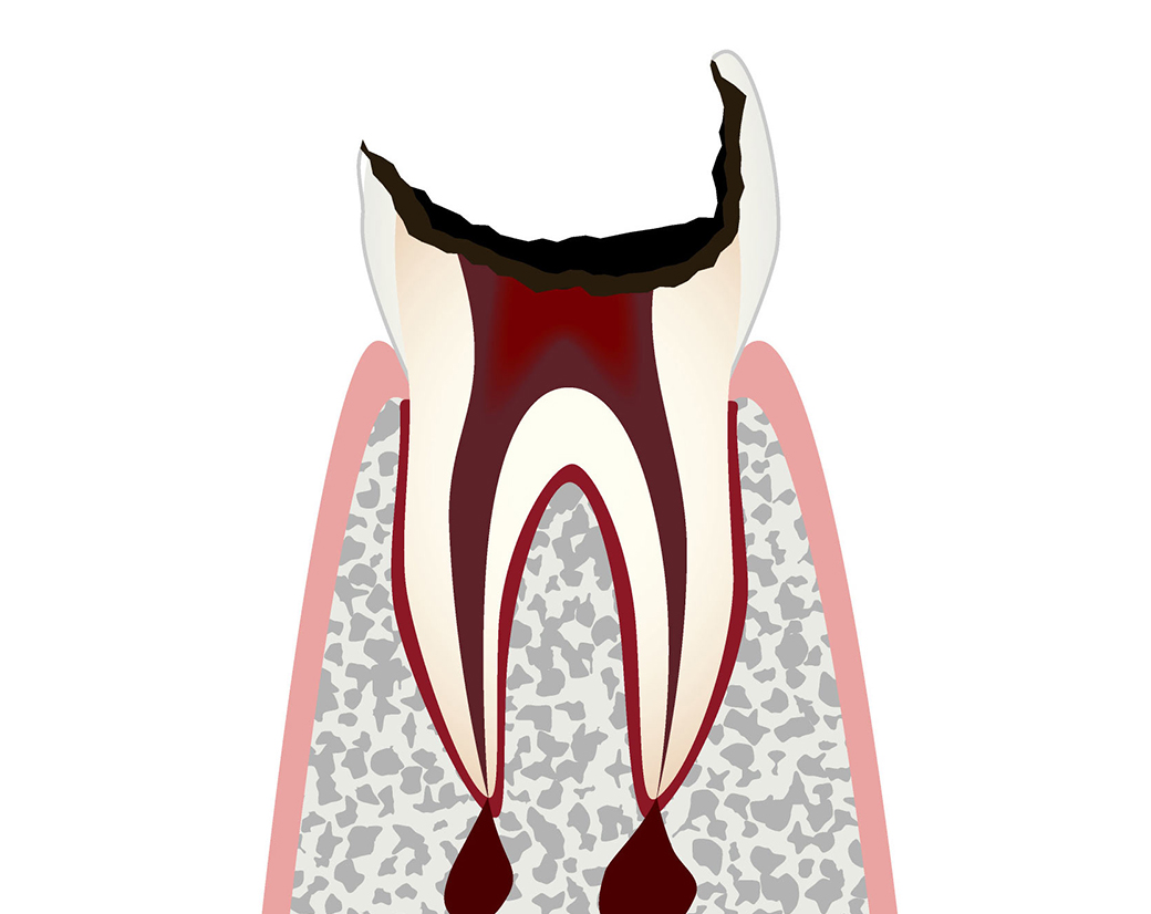 C4：歯の根しか残っていない状態