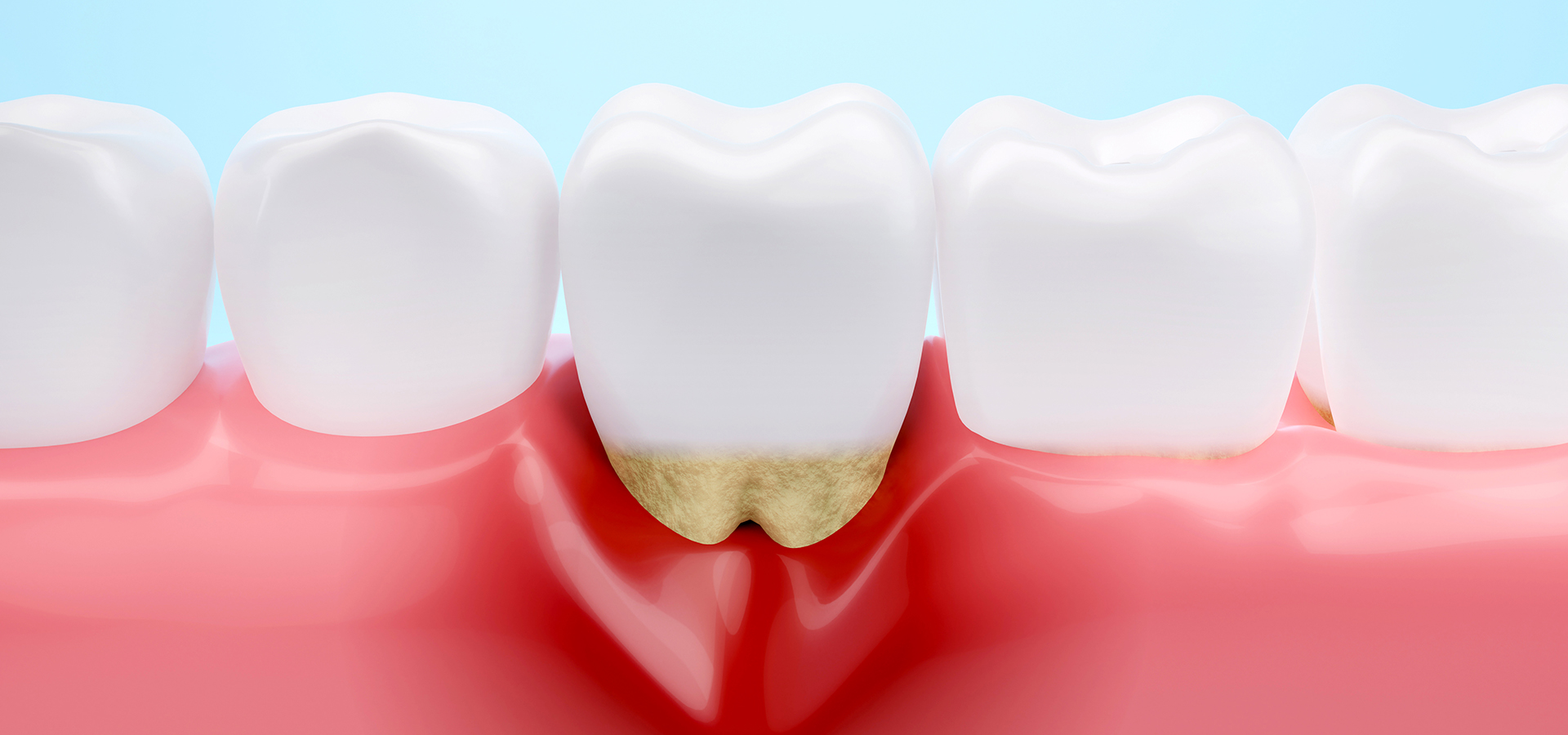歯周病とはどんな病気でしょう？