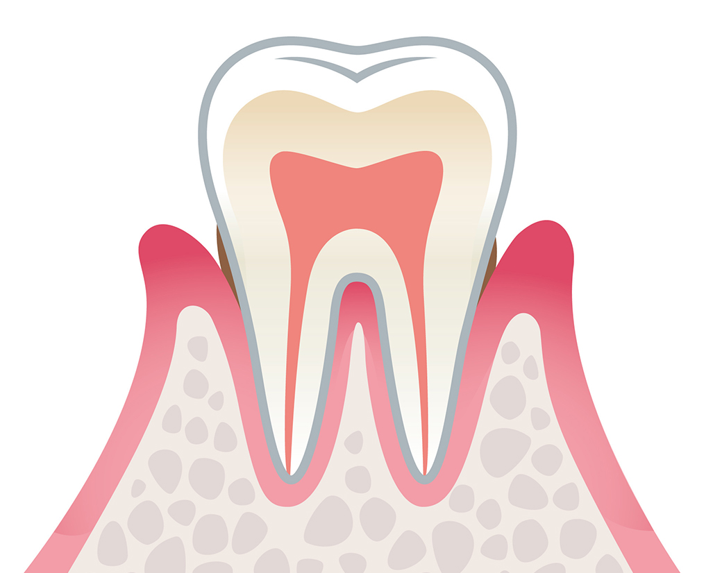 歯周炎（軽度）