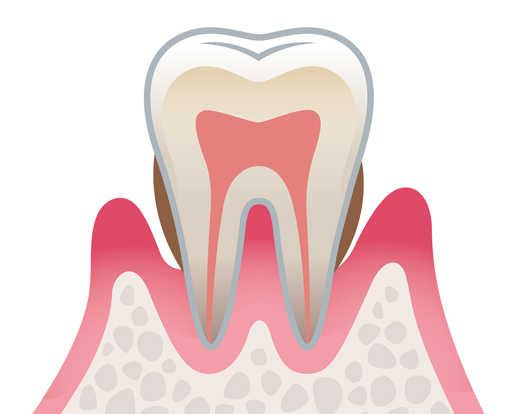 歯周病（中度）