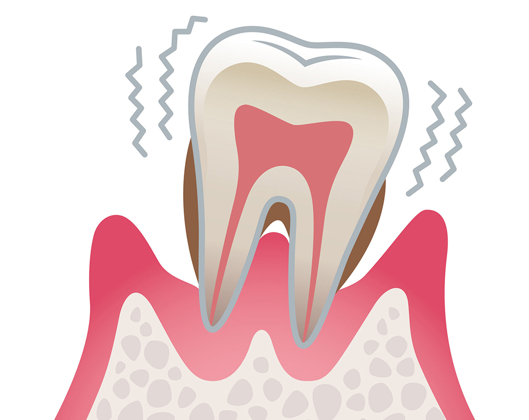 歯周病（重度）