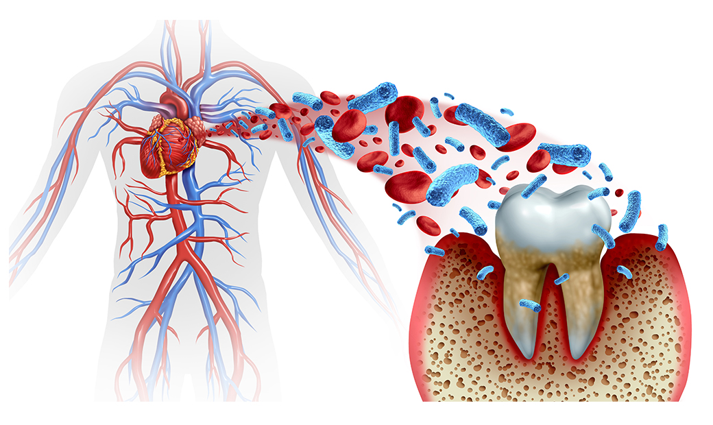歯周病と全身疾患との関連性